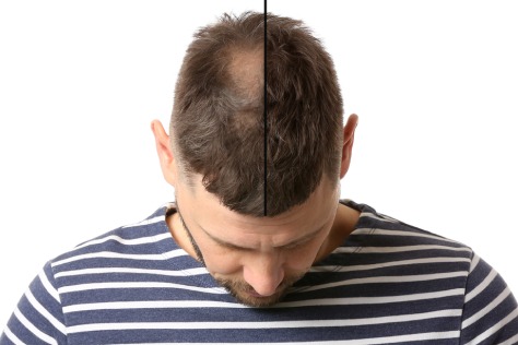 Hair specialist doctor in Hyderabad
