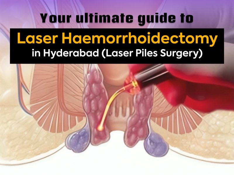 Laser Haemorrhoidectomy | Advanced Piles Treatment in Hyderabad